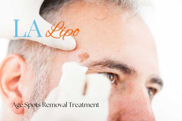 What Are the Most Effective Treatments for Age Spots Enfield Lock?