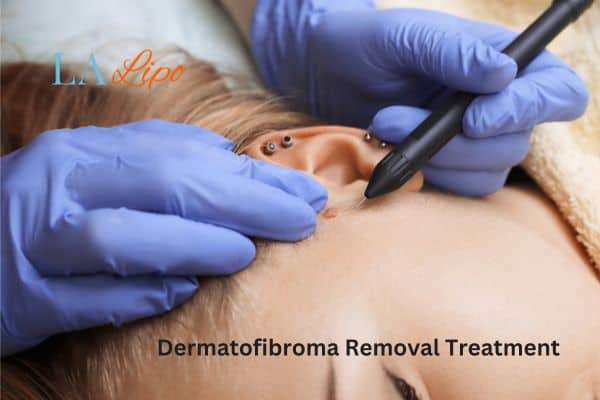 Dermatofibroma Removal Treatment Enfield Lock