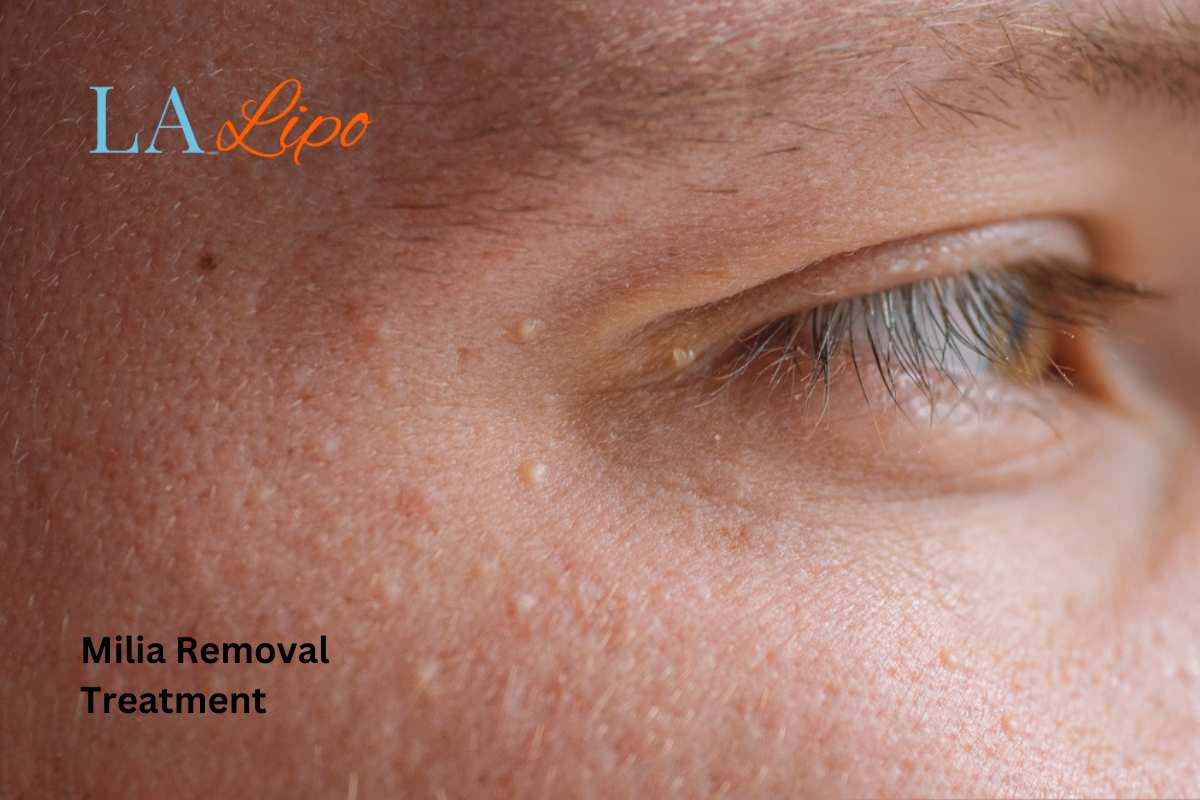 Cryopen Milia Removal: Is It the Easiest and Safest Option Enfield Lock?