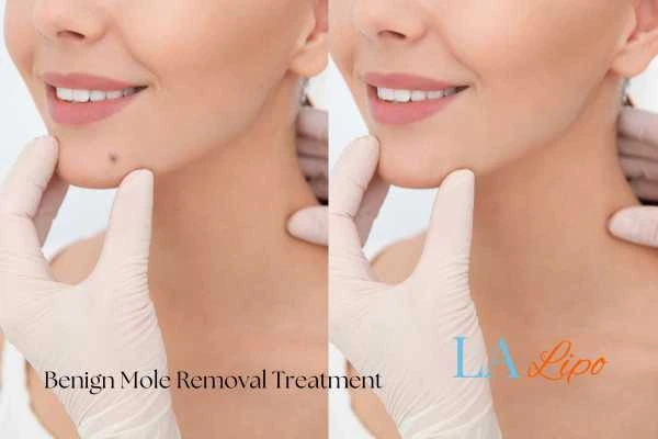 woman's before and after mole removal Enfield Lock results