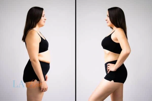 image of woman before and after results of LA-EMS Body Sculpting Enfield Lock to help treat Diastasis recti