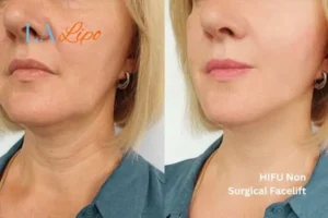 hi-fu for wrinkles Enfield Lock before and after results