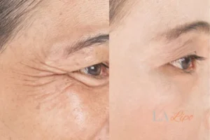 Before and after results of woman - HI-fu wrinkles reduction treatment Enfield Lock