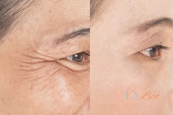 Before and after results of woman - HI-fu wrinkles reduction treatment Enfield Lock