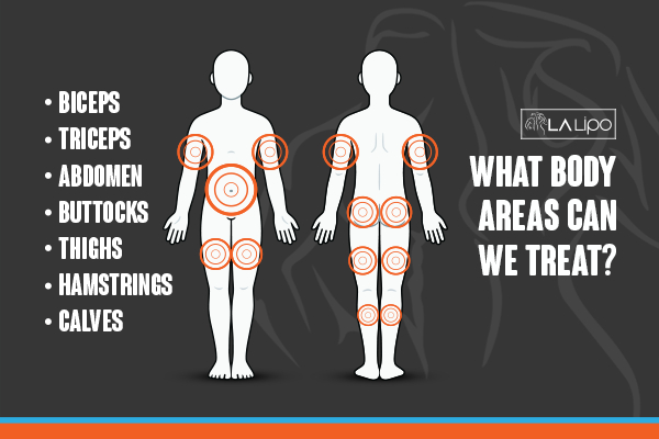 Graphic to show areas you can have LA-EMS Body Sculpting Enfield Lock treatment.
