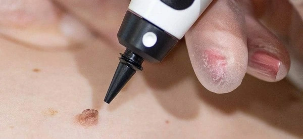 skin tag removal using cryopen Enfield Lock