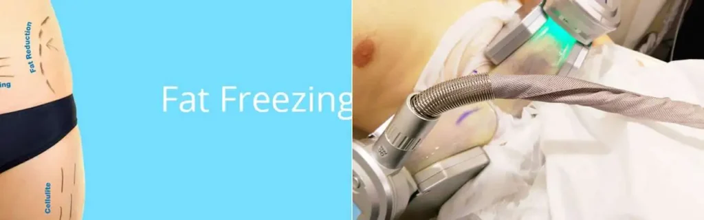 Fat freezing Enfield Lock on multiple areas of the body