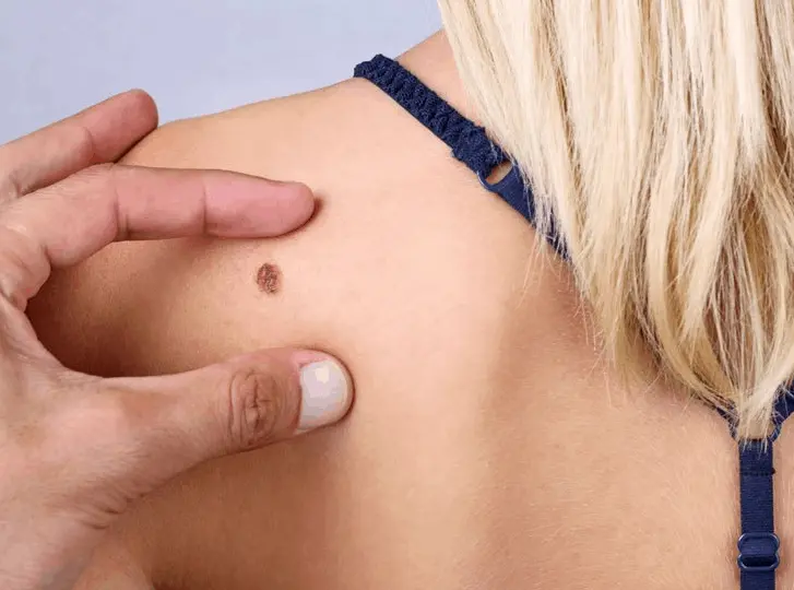 woman having mole removal Enfield Lock consultation before treatment.