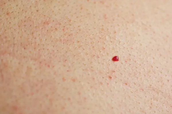 close up of a cherry angioma Enfield Lock