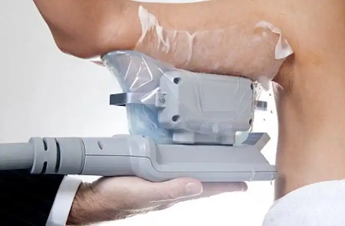 Picture of fat freezing Enfield Lock on the upper arms.