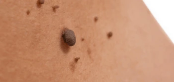 image of a skin tag Enfield Lock