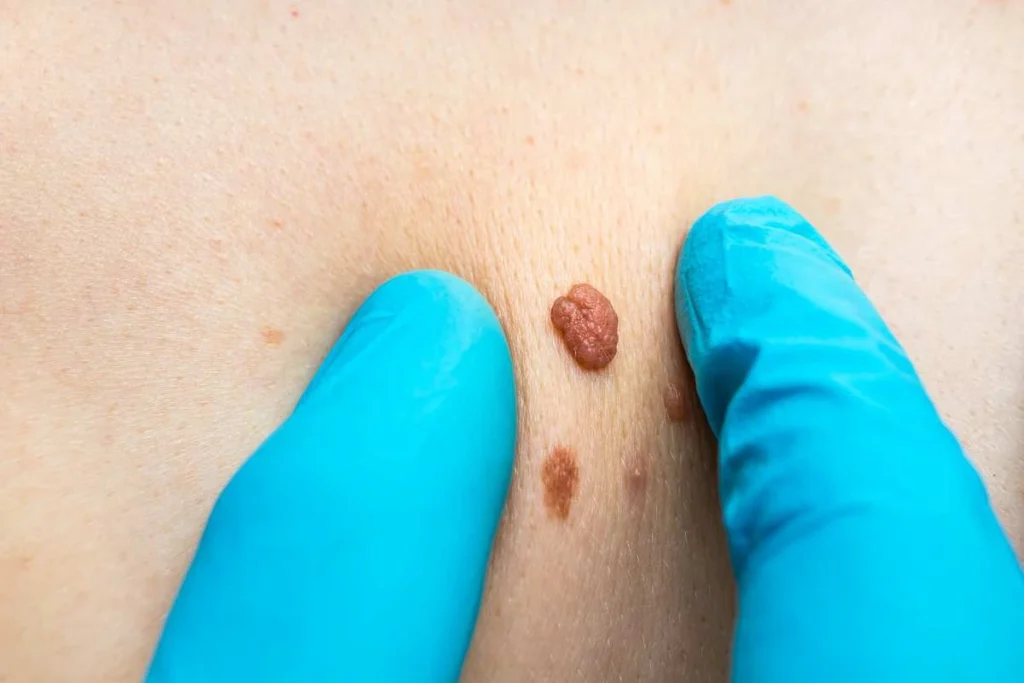 Consultant examining a skin tag Enfield Lock
