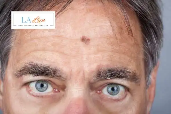 Solar Lentigo Removal Enfield Lock image of man with mark on his forehead