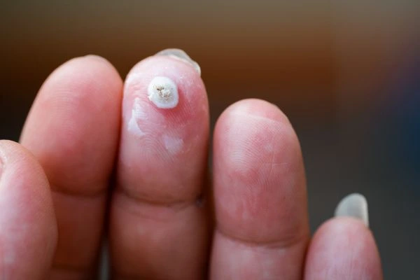 wart on person finger - cryotherapy to treat from LA LIPO Enfield Lock