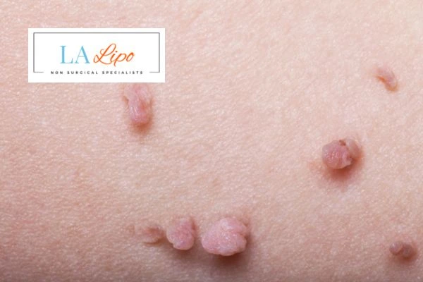 Does cryopen skin tag removal Enfield Lock hurt? Find out now call our team today!