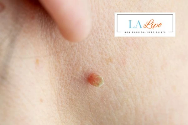 Book skin tag removal Enfield Lock today speak to our team now!