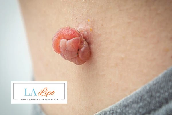 Interested in skin tag removal Enfield Lock? Concerned about the pain? Find out more today!