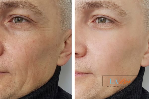See the amazing results of Morpheus8 Treatment Enfield Lock!