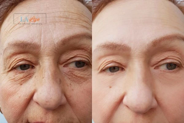The powerful benefits of Morpheus8 Treatment Enfield Lock - Call Our team today!