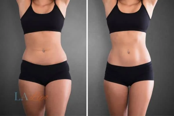 before and after results of non-surgical treatment to help a woman's body image and mental health Enfield Lock