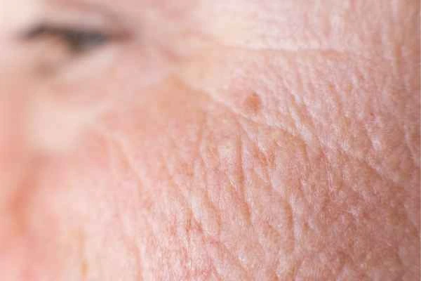 close up picture of a woman's face showing an age spot Enfield Lock