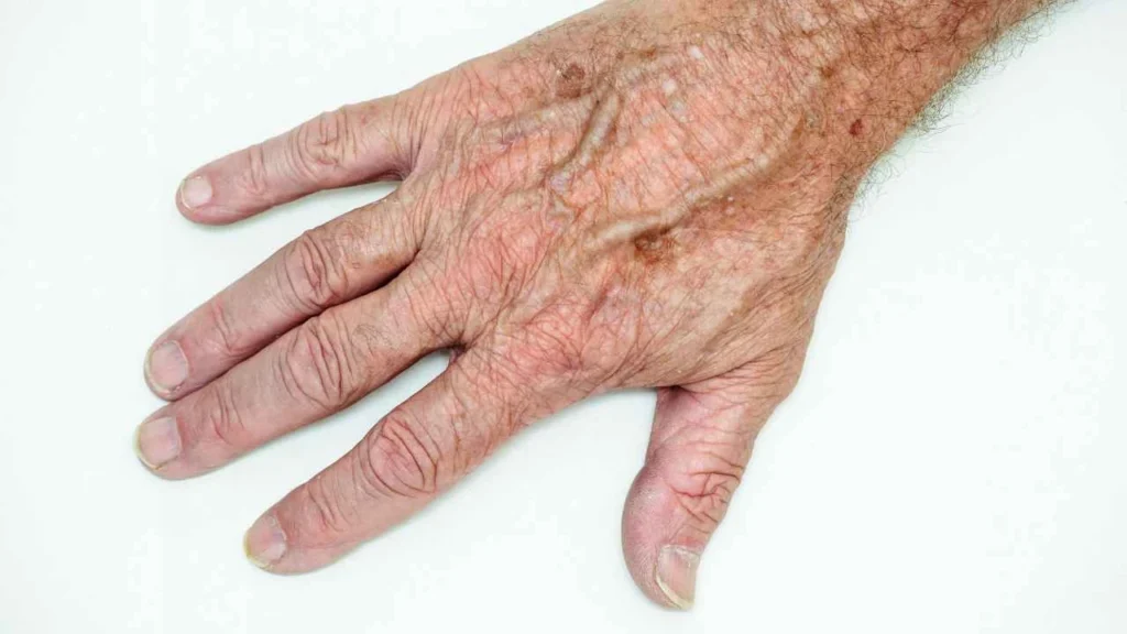 Male hand showing age spot Enfield Lock