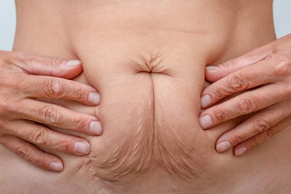 Image of a woman's stomach with loose skin - example of skin tightening Enfield Lock options