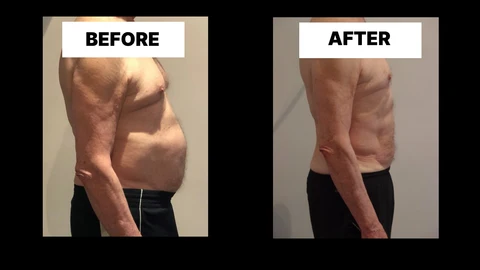 What Symptoms Can Diastasis Recti Cause in Men? Weak Core, Back Pain and Poor Posture Enfield Lock